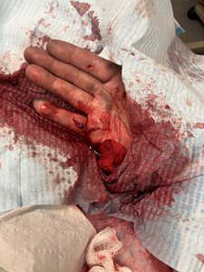wounded hand