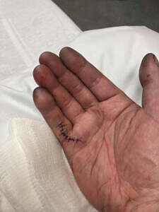 stitches